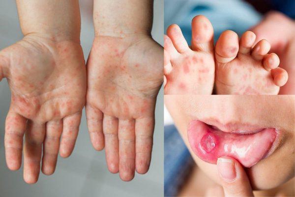 Gia tăng số ca mắc bệnh chân tay miệng