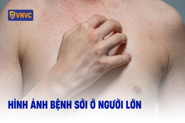 Công điện của Thủ tướng Chính phủ về việc đẩy nhanh tiêm chủng vaccine phòng, chống bệnh Sởi